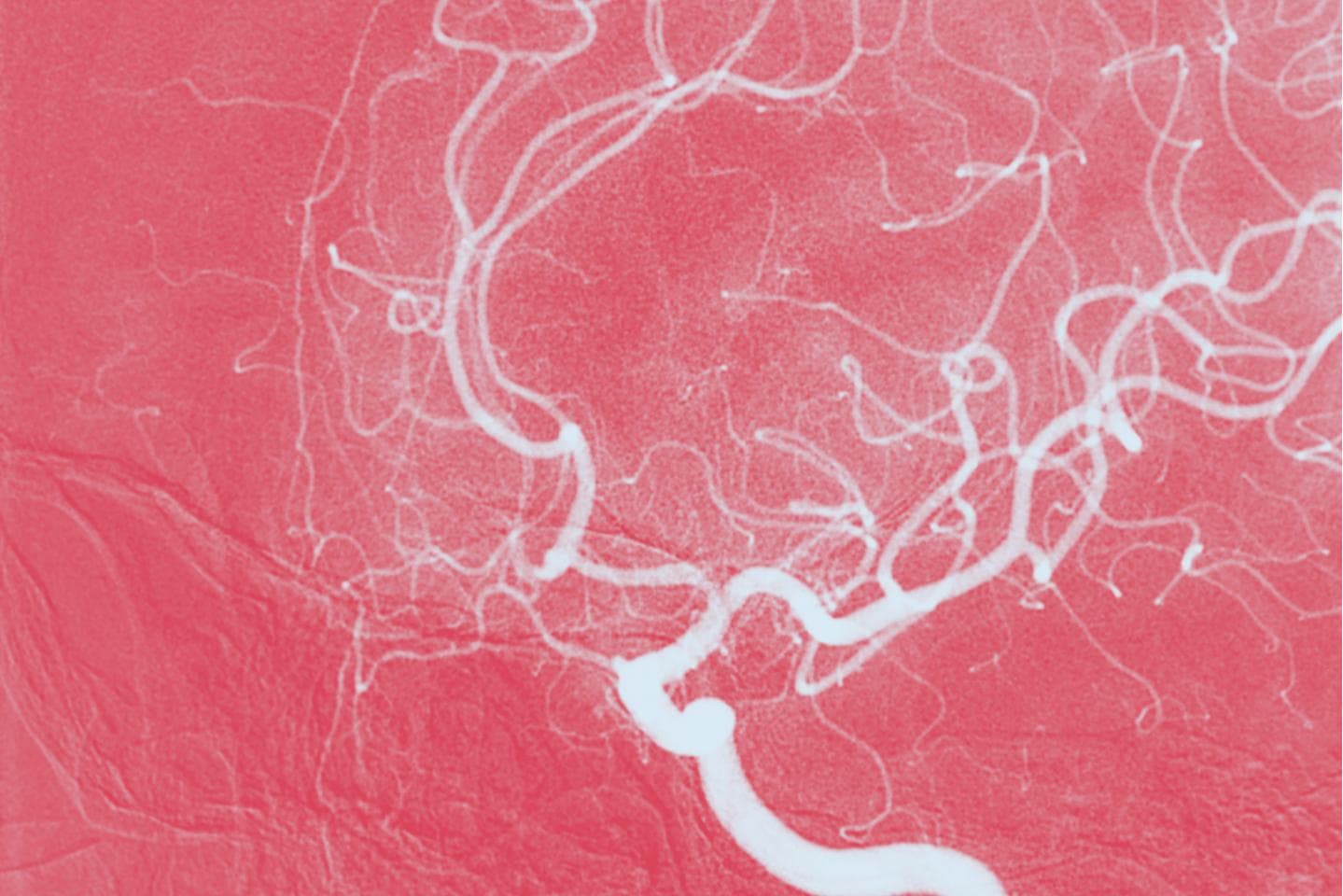 Internal carotid artery DSA image